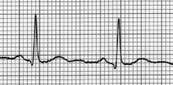 EKG